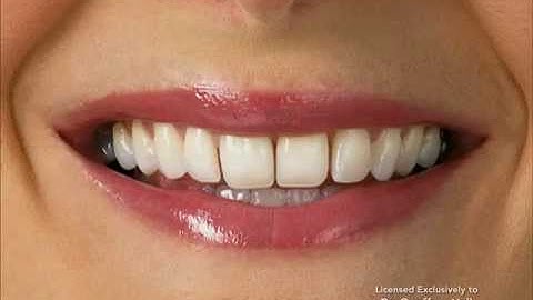 Advanced Orthodontics - IPR