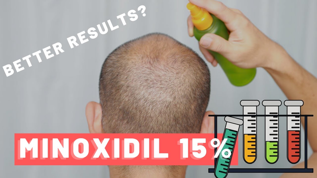 Minoxidil 15% Is It Safe? Does It Work? Should you use it? - YouTube
