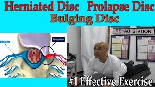 Herniated Disc, Prolapse Disc, Bulging Disc (# 1 Effective Exercise) Dr Mandell