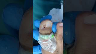 Cosas que NO debes hacer si tienes una UÑA ENCARNADA #podologo