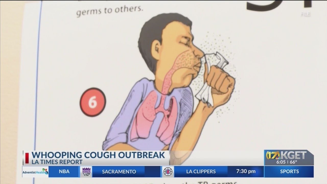 Cases of whooping cough rising in California in 2024