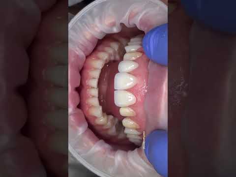 Dán veneer toàn hàm tự nhiên, mỏng nhẹ tại Nha khoa Việt Hàn  #nhakhoanhatrang