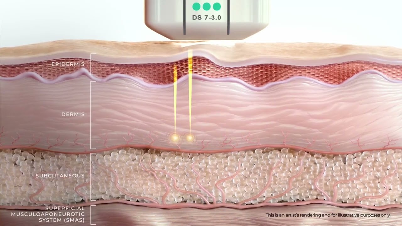 Ultherapy Prime Face Lifting and Skin tightening