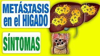 Todos los Síntomas de las Metástasis en el Hígado