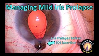 Managing Mild to Moderate Iris Prolapse & Floppy Iris during Cataract Surgery