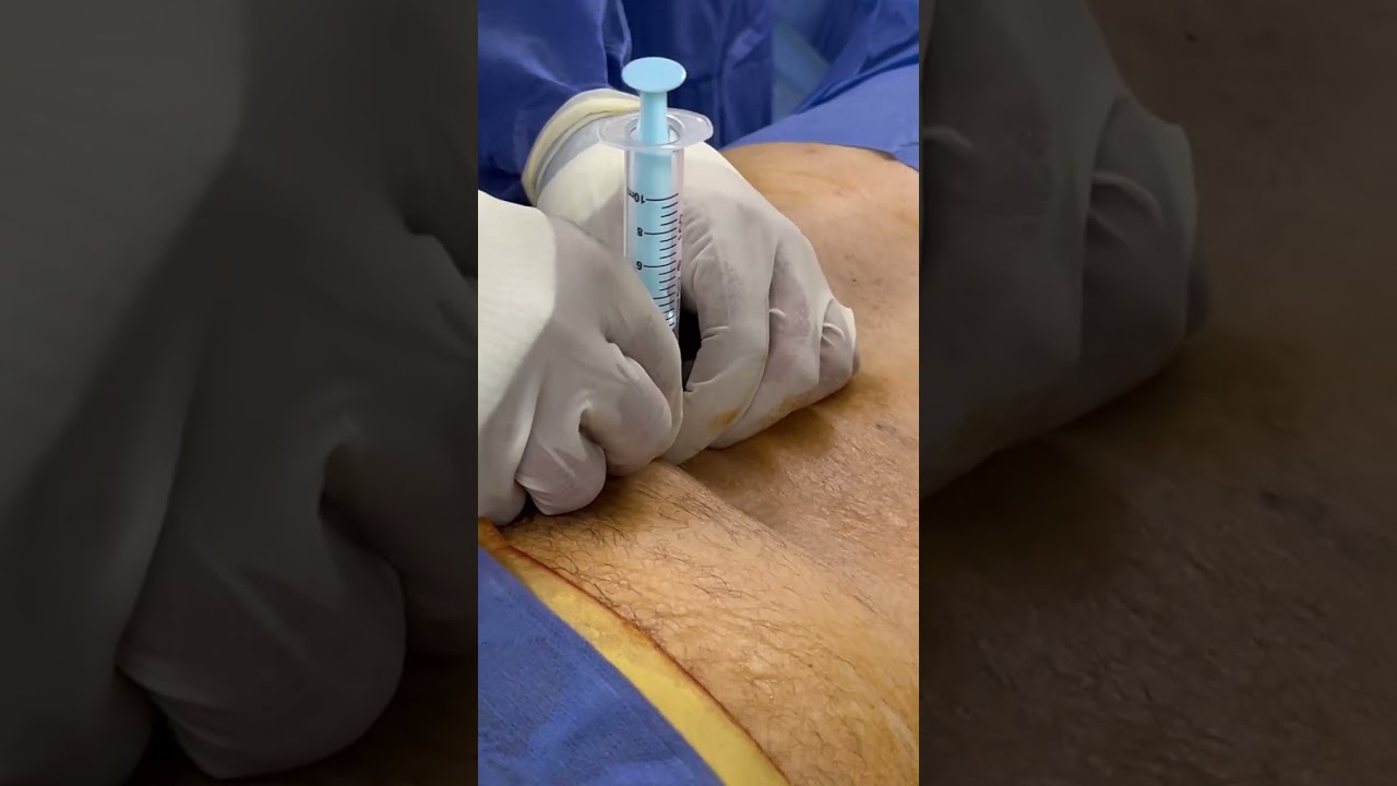 Interlaminar epidural steroid injection under fluoroscopic guidance