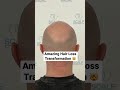 Top Hair Loss Solution for Instant Results 💇‍♂️
