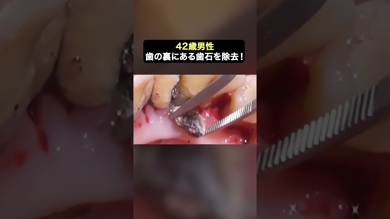 20年以上溜まった大量の歯石をスッキリ除去✨