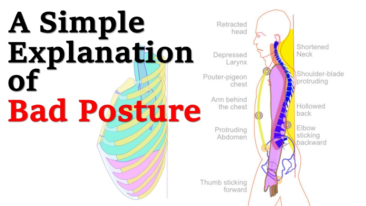 Простое объяснение плохой осанки