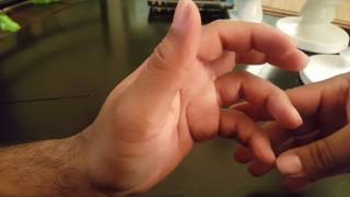 Flexor Tendon Injury Post surgery/Therapy @ 2 weeks