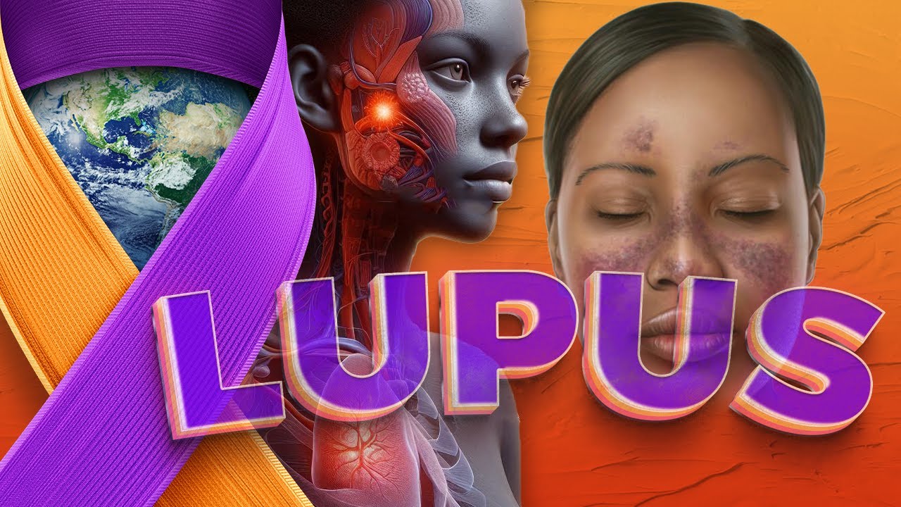 Natural Health Solutions For LUPUS