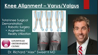 Understanding the Varus/Valgus Knee Alignment screenshot 3