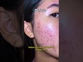 fixing your acne, pigmentation, and redness #azelaicacid #skincare #acnetreatment #darkspots