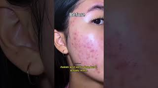 fixing your acne, pigmentation, and redness #azelaicacid #skincare #acnetreatment #darkspots