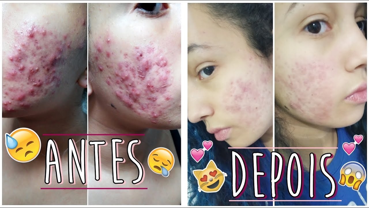 Tratamento com Roacutan 4° Mês | com fotos - YouTube