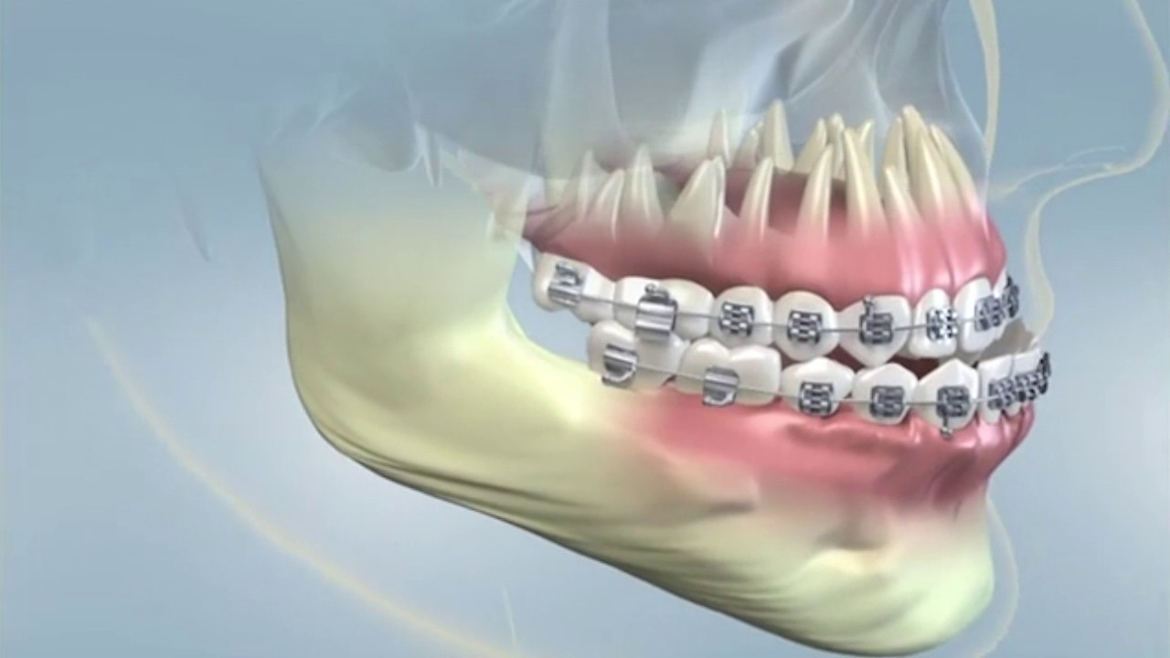 Lower Jaw Protrusion YouTube
