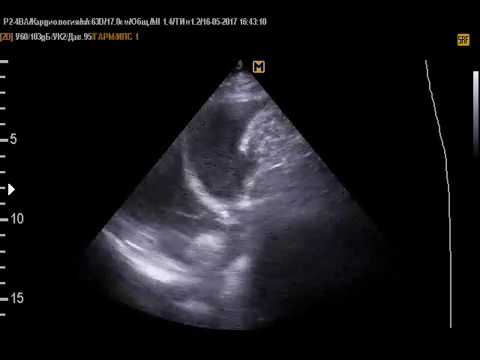 Жидкость в плевральной полости на УЗИ легких(16-5-17)