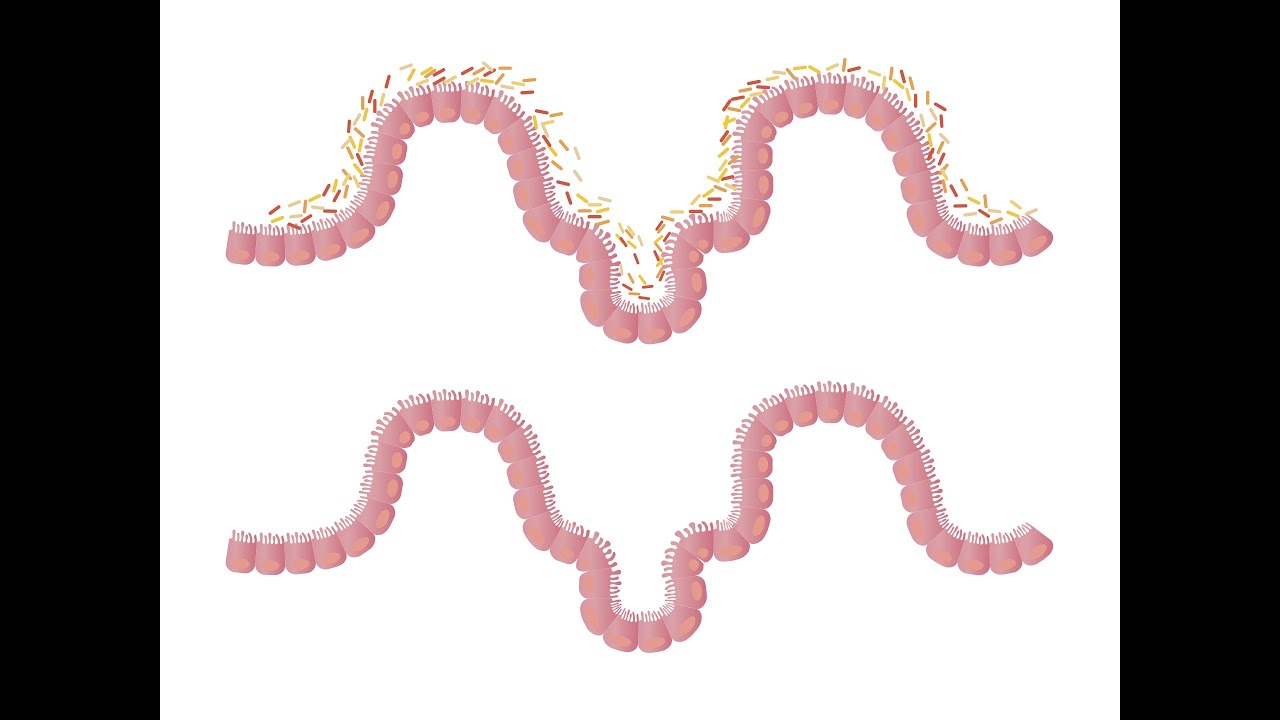 Leaky Gut Syndrome Treatment