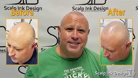 Scalp Micropigmentation in South Florida - A Phenomenal Experience at Scalp Ink Design