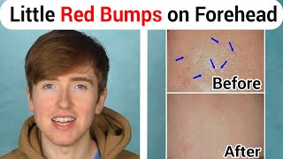 How to Get Rid of Little Red Bumps on Forehead - Fungal Acne Malassezia by Sam Clegg 3,360 views 4 years ago 6 minutes