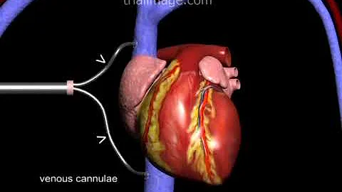 Cardiopulmonary Bypass (in 2 minutes) Animation by Cal Shipley, M.D.