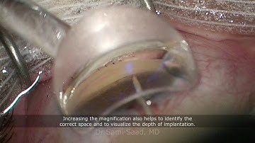 Combined cataract surgery with iStent Inject W ("Wide") glaucoma device implantation