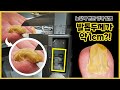 무좀발톱이 돌아왔다! 어마어마한 두께, 시원하게 관리 해 드렸습니다! (2편) / athlete&#39;s foot