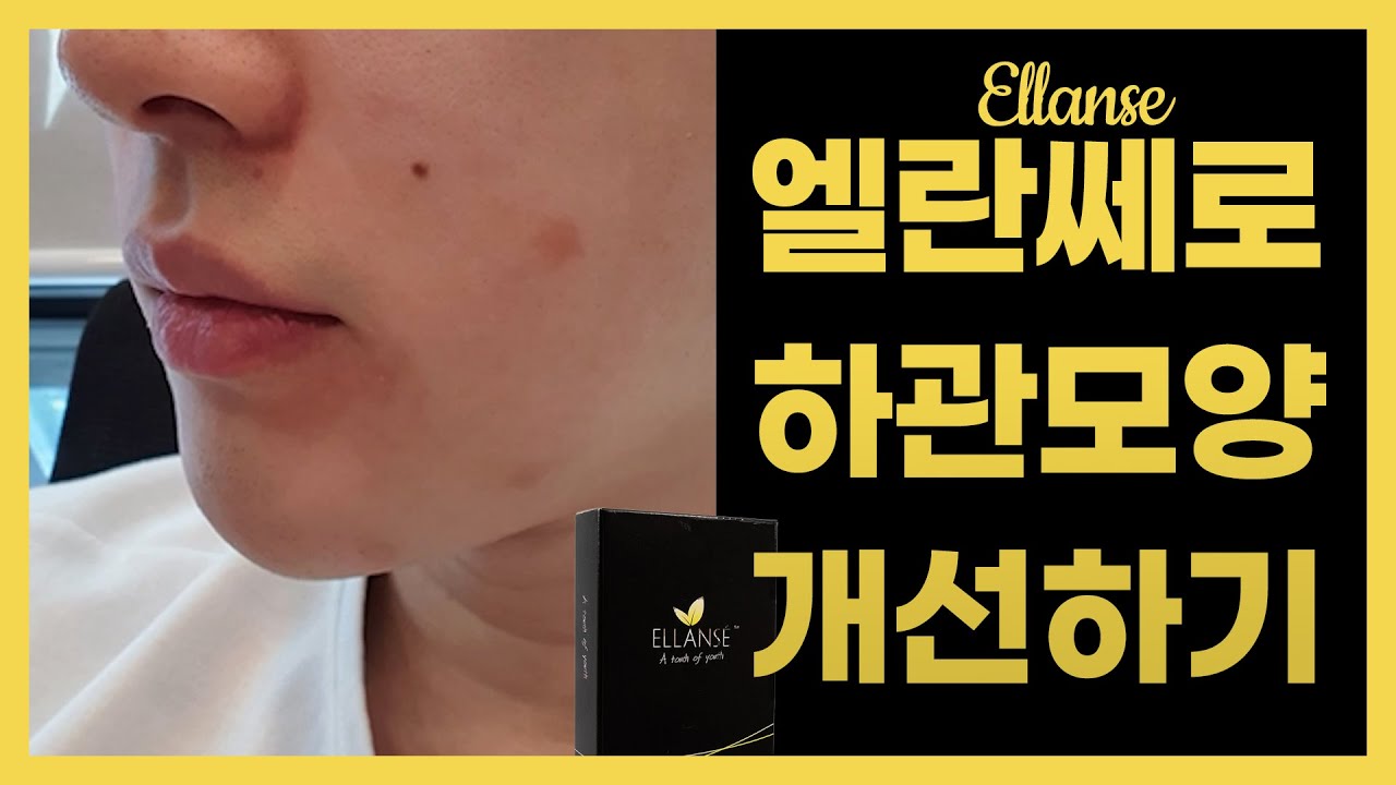 엘란쎄로 남자 하관 모양을 바꿀 수 있다?! [엘란쎄 남자 하관] - YouTube