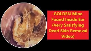 GOLDEN Mine Found Inside Ear (Very Satisfying Dead skin Video) | Tr. Hoan-TER