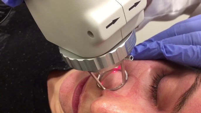 Fractional CO2 Laser Skin Resurfacing - Full Face! - YouTube