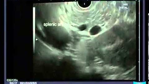 Radial Endoscopic Ultrasound - Anatomical Guiding Structures in the Upper Abdomen