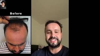 Fort Lauderdale Hair Transplant Clinic | Hair Transplant Cost in Fort Lauderdale