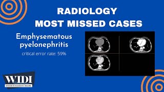 Most Missed Cases: Emphysematous Pyelonephritis