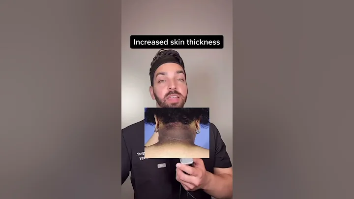 Darker Neck - DermDoctor Explains Acanthosis Nigricans #shorts