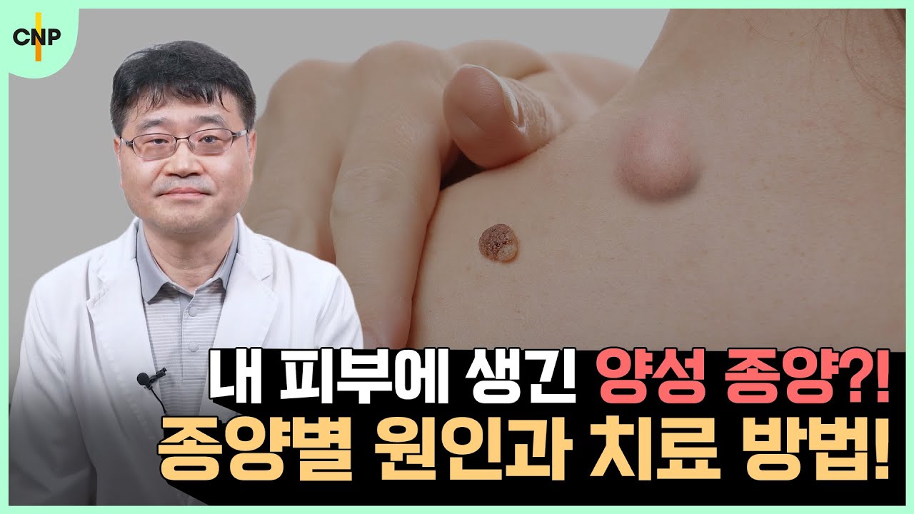 "피부에 발생하는 양성 종양!" 종양별 원인과 치료방법 알려드립니다!