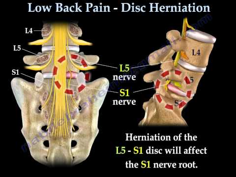 A herniated disc occurs when the soft gelatinous core of an intervertebral disc pushes out through a. 