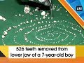 Stomatolog sedmogodišnjem dječaku izvadio 526 zuba