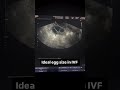What an Ideal IVF Follicle Ultrasound Looks Like | Guided by Dr. Astha | Asha IVF &amp; Fertility centre