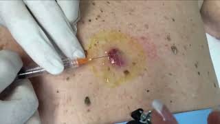 Top Pops!  Pimples, Cysts, Blackheads & Dilated Pores