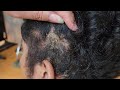 Dandruff scratching removal on head using black combing #E33