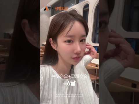 눈재수술+코재수술 6달 변화 실화?😲 #눈코성형