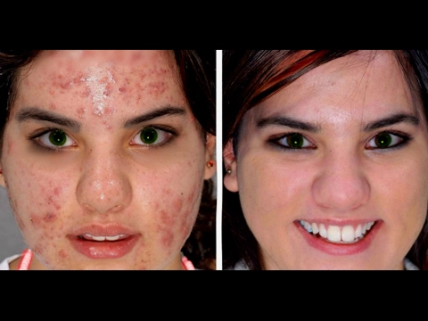 REMEDIO CONTRA EL ACNE: ZINC/cómo tomar zinc para curar el ACNE/ Zinc for Acne