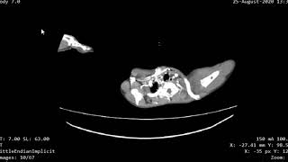 Case 945 CT Chest lung contusion