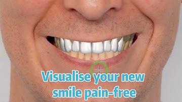 Exocad Mock-up digital smile design