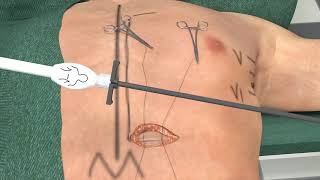 Intermuscular Implant Technique S-Icd - Boston Scientific