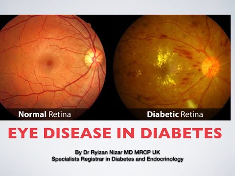 8.DiabetesConnect-Eye disease in Diabetes (Diabetic Retinopathy)By Dr Ryizan Nizar MD MRCP UK