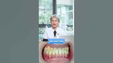 NIỀNG RĂNG CẤP TỐC ĐIỀU TRỊ KHE THƯA, KHỚP CẮN NGƯỢC