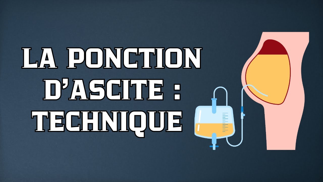 La ponction d’ascite : Explication très simple