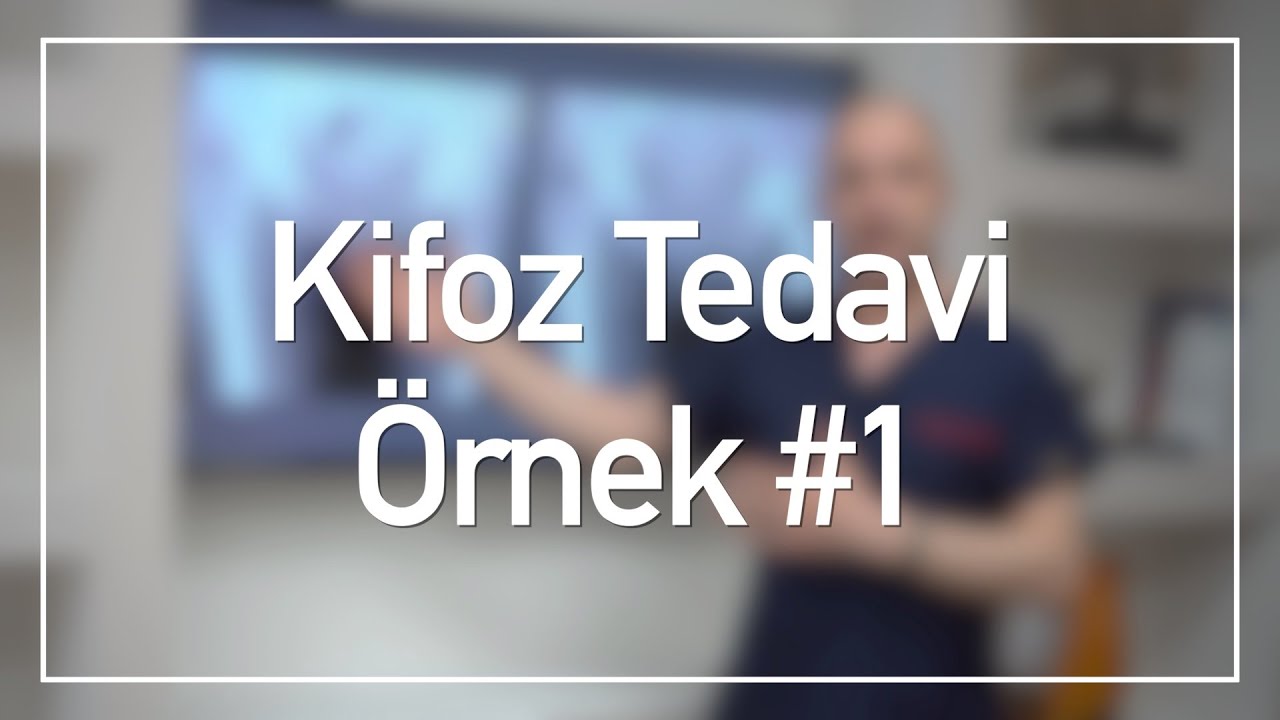 36 Yaş Kamburluk Tedavisi | Kifoz - Kamburluk Tedavi Örnekleri #1