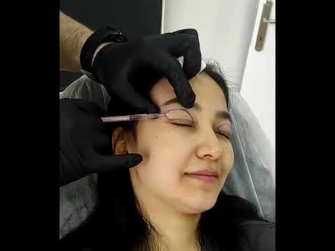 Üst Göz Kapağı Ameliyatı, Upper Eyelid Surgery